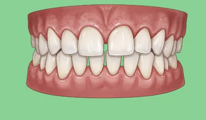 Niềng răng mức độ 2 (Trung bình) - minh hoạ tình trạng sai lệch răng tại Teennie