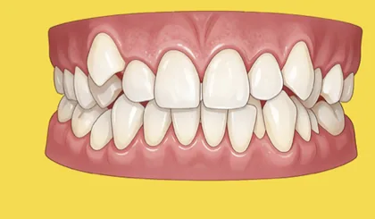 Niềng răng mức độ 3 (Khá) - minh hoạ tình trạng sai lệch răng tại Teennie