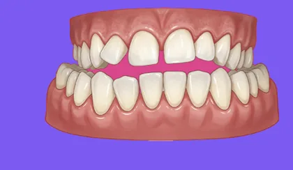 Niềng răng mức độ 4 (Nặng) - minh hoạ tình trạng sai lệch răng tại Teennie