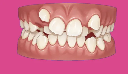 Niềng răng mức độ 5 (Phức tạp) - minh hoạ tình trạng sai lệch răng tại Teennie