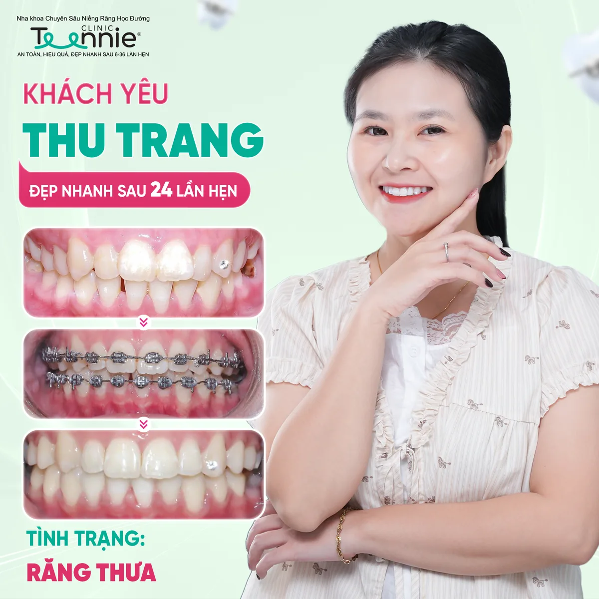 Niềng răng thưa trước và sau tại Teennie - khách hàng Thu Trang đẹp sau 24 lần hẹn