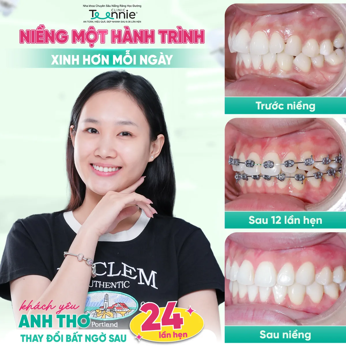 Khách hàng Anh Thơ niềng răng trước và sau tại Teennie - thay đổi bất ngờ sau 24 lần hẹn