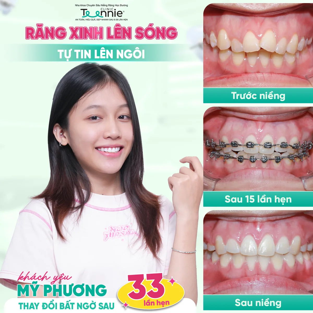 Khách hàng Mỹ Phương niềng răng trước và sau tại Teennie - thay đổi bất ngờ sau 33 lần hẹn