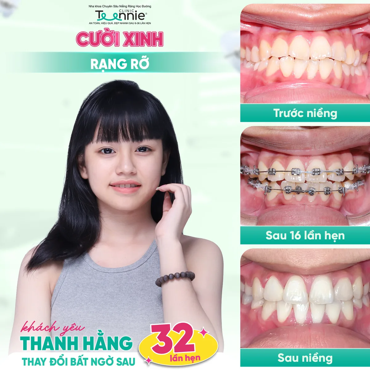 Khách hàng Thanh Hằng niềng răng trước và sau tại Teennie - thay đổi bất ngờ sau 32 lần hẹn