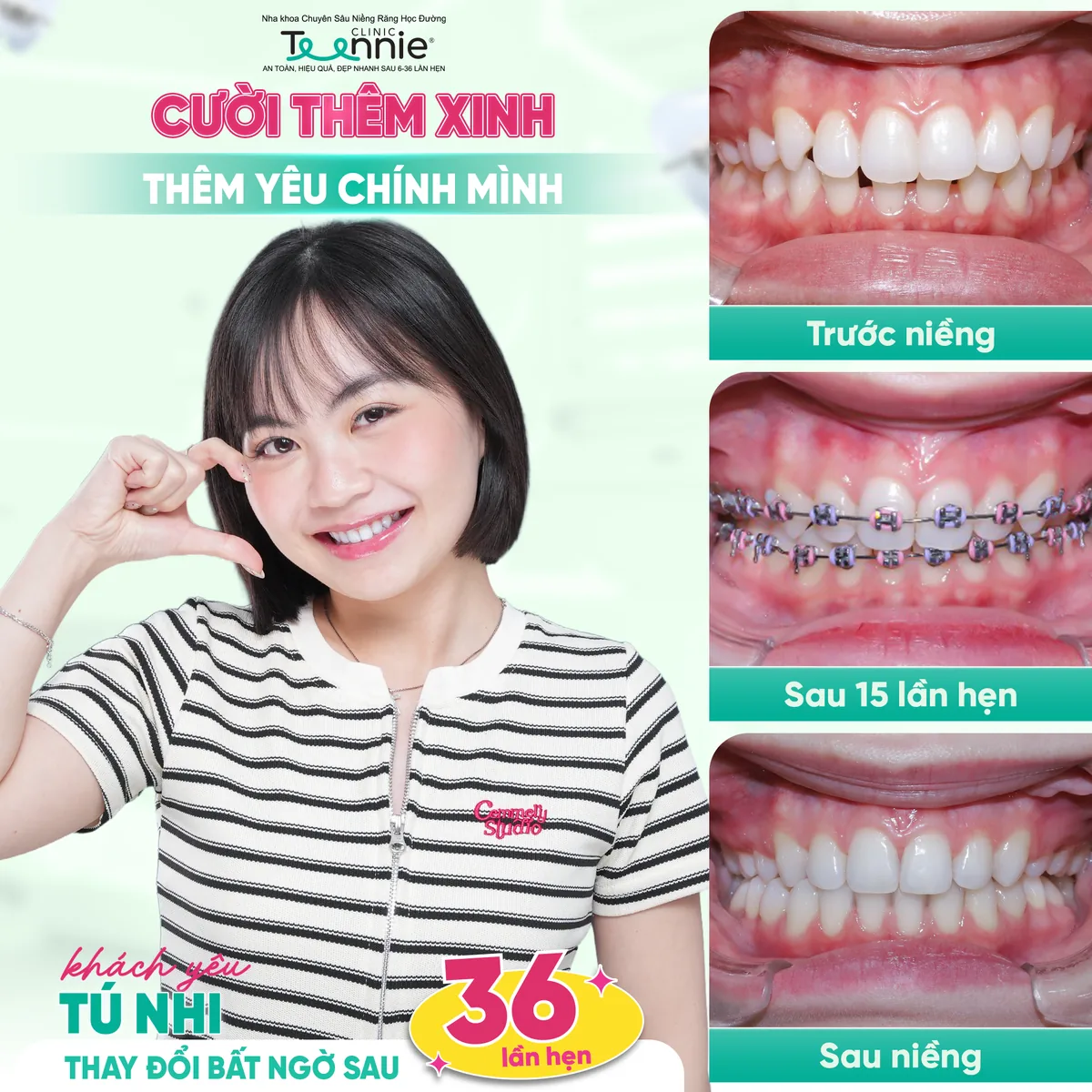 Khách hàng Tú Nhi niềng răng trước và sau tại Teennie - thay đổi bất ngờ sau 36 lần hẹn