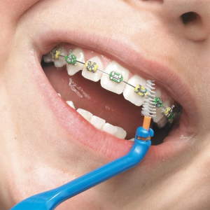Vệ sinh răng khi niềng: 6 bước đúng cách giúp hạn chế đốm trắng